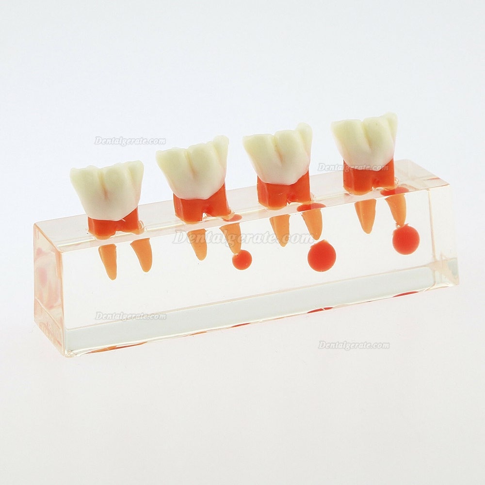 Zahnzähne Modell 4-stufige endodontische Behandlungsstudie Unterrichten Sie Modell 4018 01