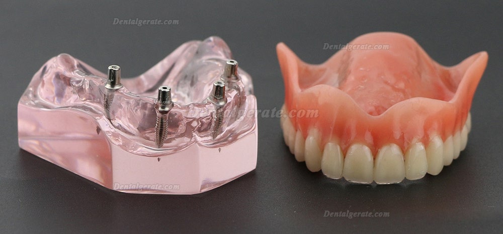 Dental Implantat rrepair Overdenture Oral Modell 6001