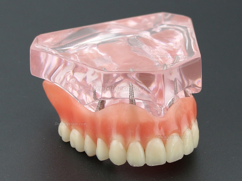 Dental Implantat rrepair Overdenture Oral Modell 6001
