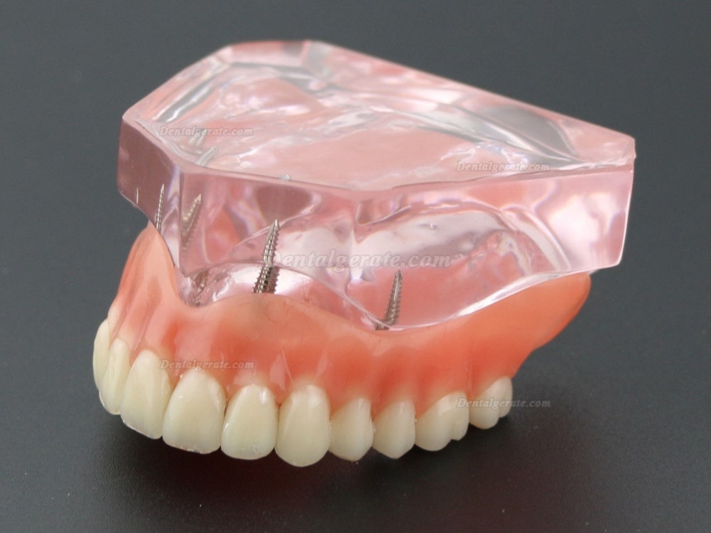 Dental Implantat rrepair Overdenture Oral Modell 6001