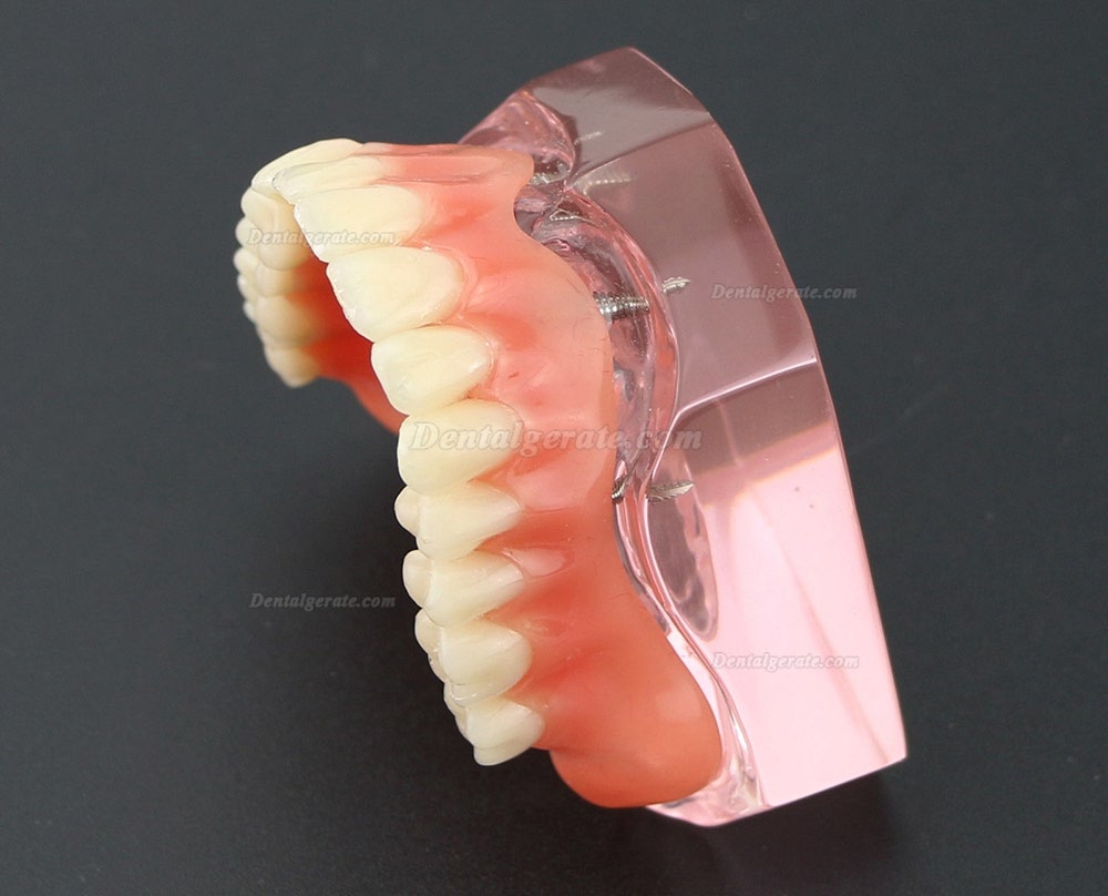 Dental Implantat rrepair Overdenture Oral Modell 6001