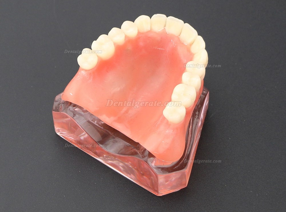 Dental Implantat rrepair Overdenture Oral Modell 6001