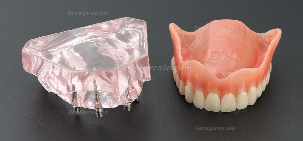 Dental Implantat rrepair Overdenture Oral Modell 6001