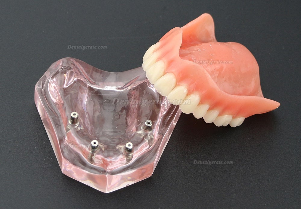 Dental Implantat rrepair Overdenture Oral Modell 6001