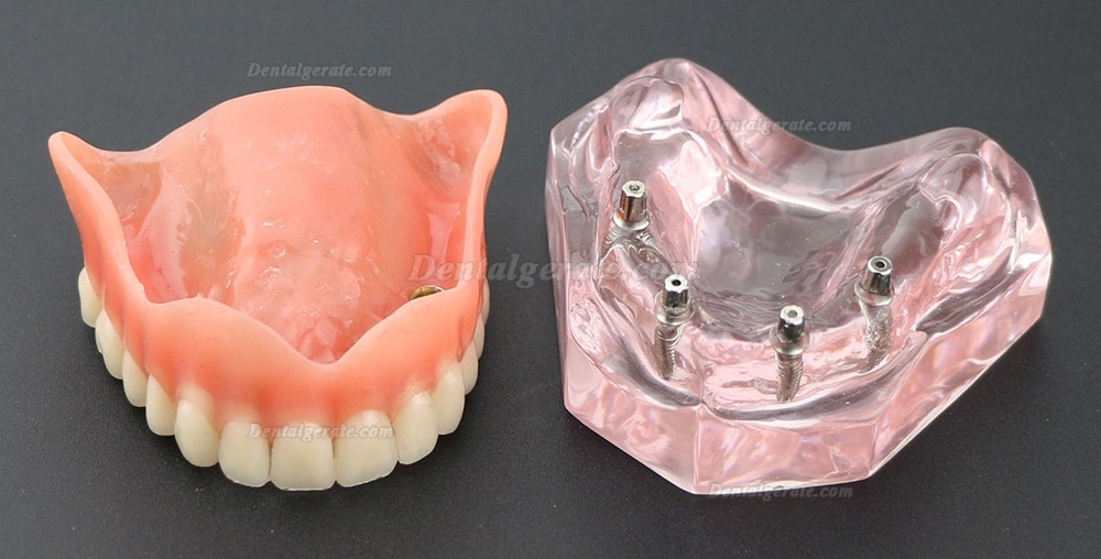 Dental Implantat rrepair Overdenture Oral Modell 6001