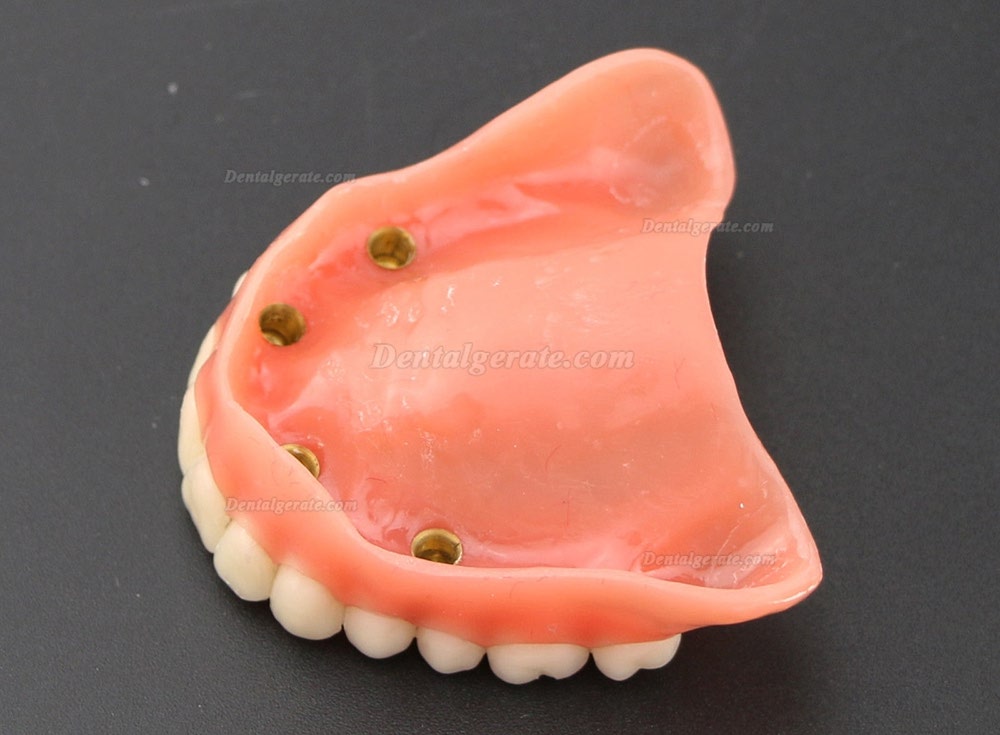 Dental Implantat rrepair Overdenture Oral Modell 6001
