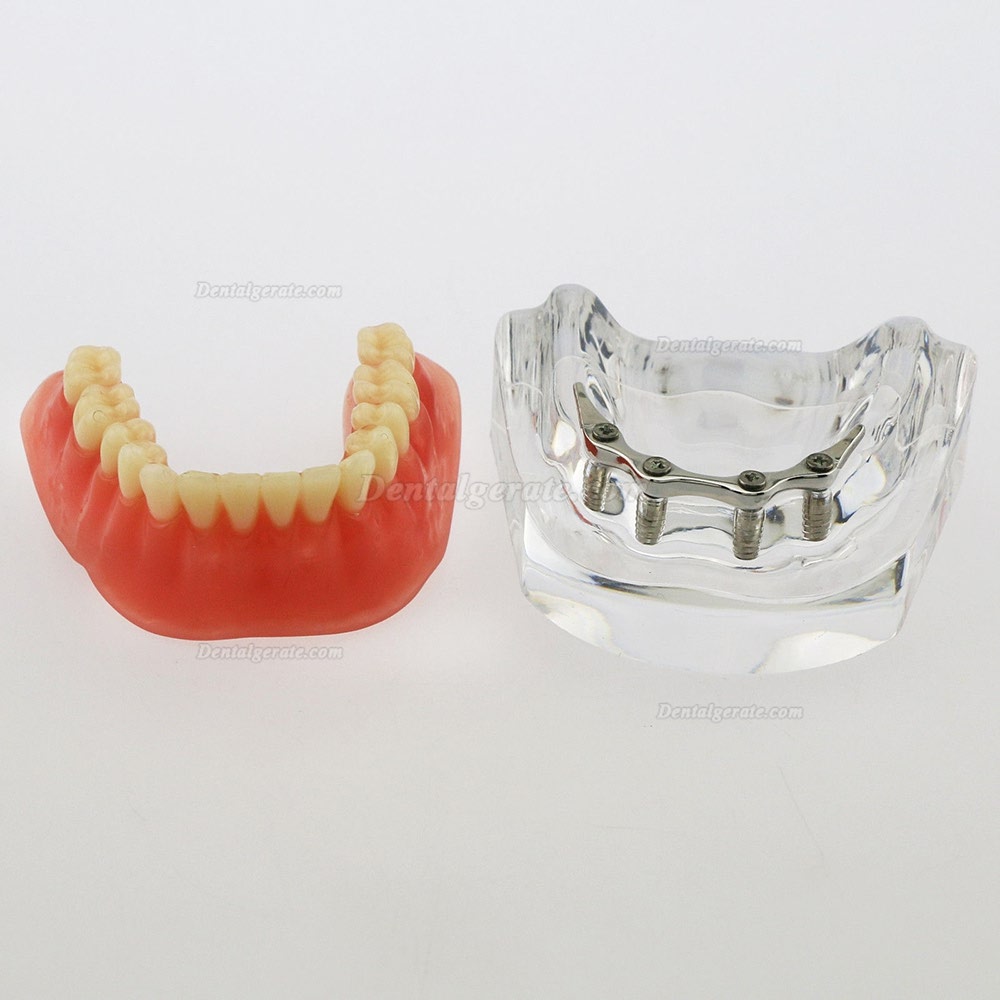 Dental Minderwertige Zähne Modell Overdenture Precision 4 Implantate Demo Silver Bar Dental Minderwertige Zähne Modell Overdenture Precision 4 Implantate Demo Silver Bar