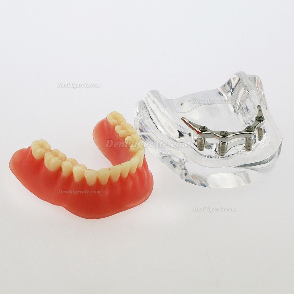 Dental Minderwertige Zähne Modell Overdenture Precision 4 Implantate Demo Silver Bar Dental Minderwertige Zähne Modell Overdenture Precision 4 Implantate Demo Silver Bar
