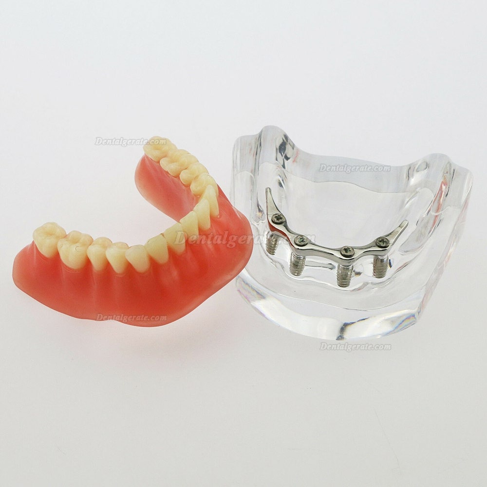 Dental Minderwertige Zähne Modell Overdenture Precision 4 Implantate Demo Silver Bar Dental Minderwertige Zähne Modell Overdenture Precision 4 Implantate Demo Silver Bar