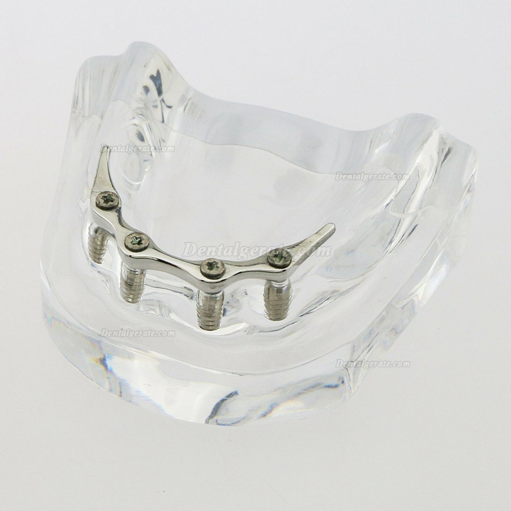 Dental Minderwertige Zähne Modell Overdenture Precision 4 Implantate Demo Silver Bar Dental Minderwertige Zähne Modell Overdenture Precision 4 Implantate Demo Silver Bar
