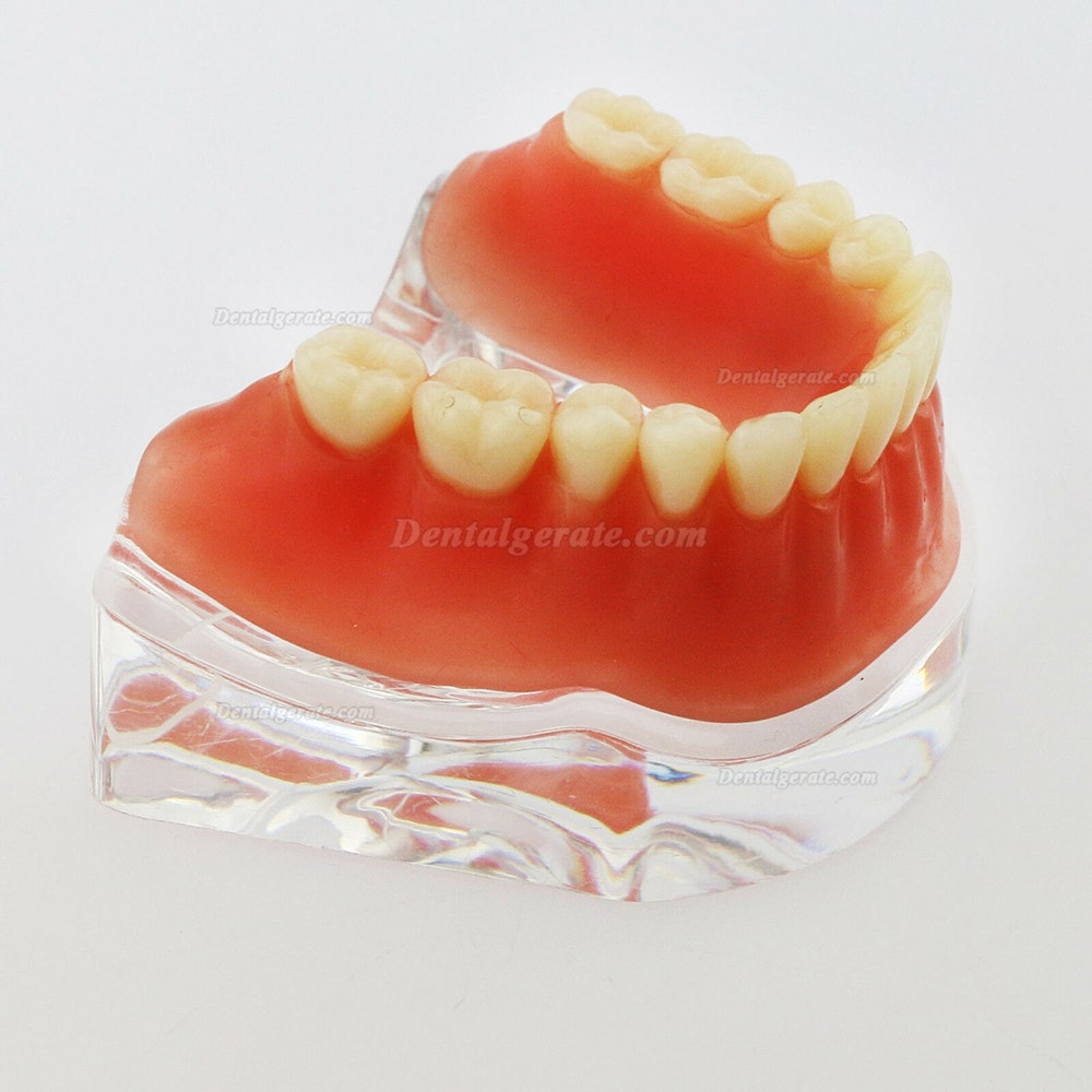 Dental Minderwertige Zähne Modell Overdenture Precision 4 Implantate Demo Silver Bar Dental Minderwertige Zähne Modell Overdenture Precision 4 Implantate Demo Silver Bar