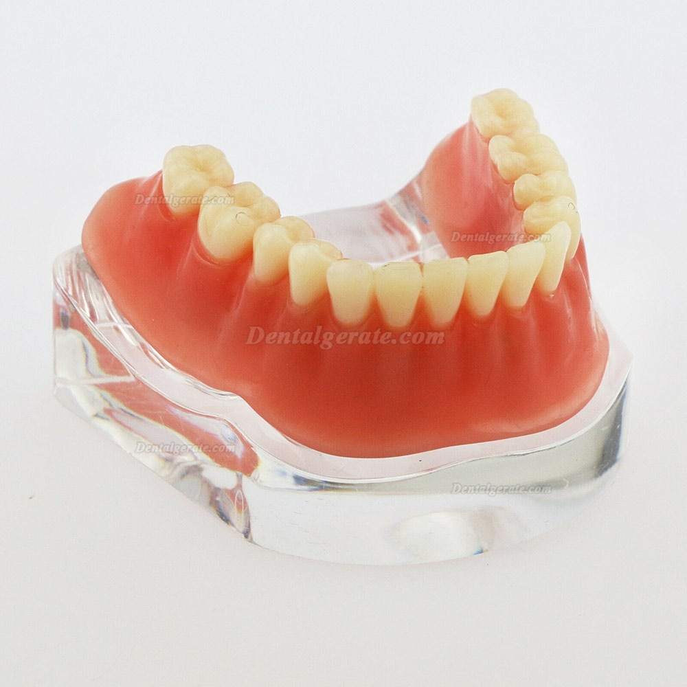 Dental Minderwertige Zähne Modell Overdenture Precision 4 Implantate Demo Silver Bar Dental Minderwertige Zähne Modell Overdenture Precision 4 Implantate Demo Silver Bar