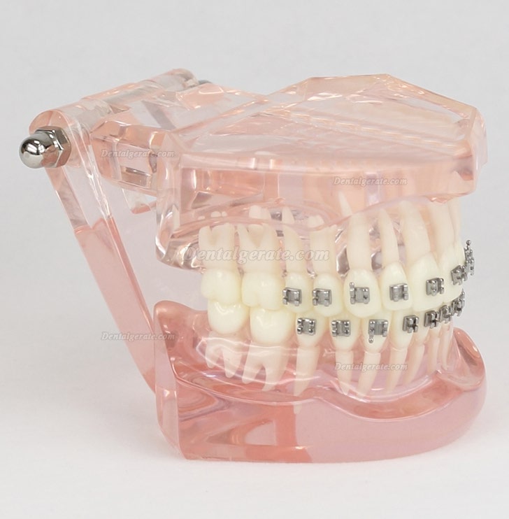M3001 Dental Kieferorthopädie Behandlung Modell Demo Zähne MetallbracketsModel M3001 Dental Kieferorthopädie Behandlung Modell Demo Zähne MetallbracketsModel