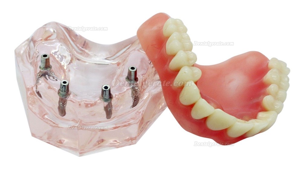 Dental Abnehmbare Overdenture Inferior mit 4 Implantaten Demo Z&auml;hne Studie Modell