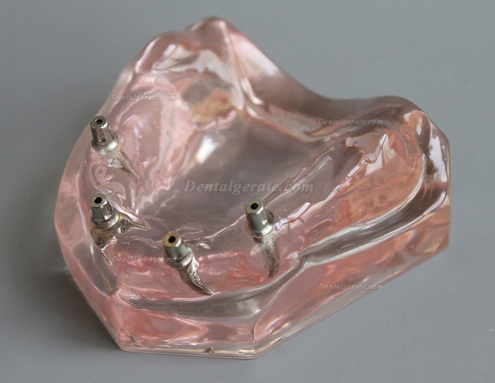 Dental Abnehmbare Overdenture Inferior mit 4 Implantaten Demo Z&auml;hne Studie Modell