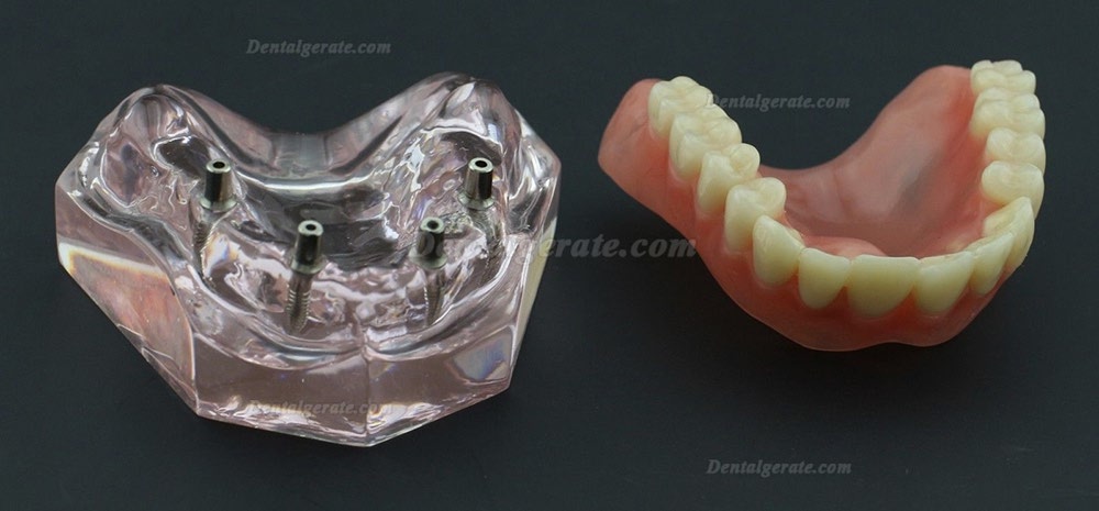Dental Abnehmbare Overdenture Inferior mit 4 Implantaten Demo Z&auml;hne Studie Modell