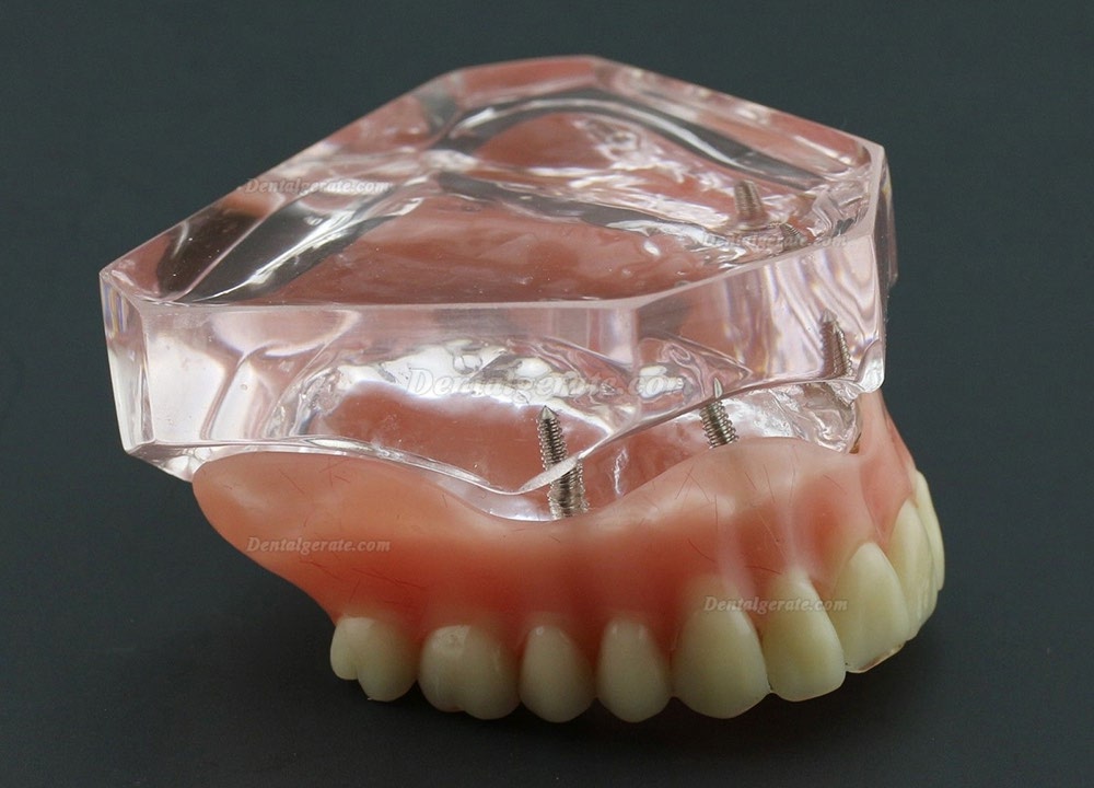 Dental Abnehmbare Overdenture Inferior mit 4 Implantaten Demo Z&auml;hne Studie Modell