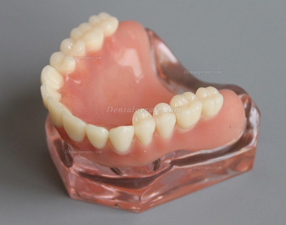 Dental Abnehmbare Overdenture Inferior mit 4 Implantaten Demo Z&auml;hne Studie Modell