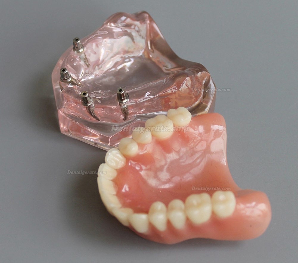 Dental Abnehmbare Overdenture Inferior mit 4 Implantaten Demo Z&auml;hne Studie Modell