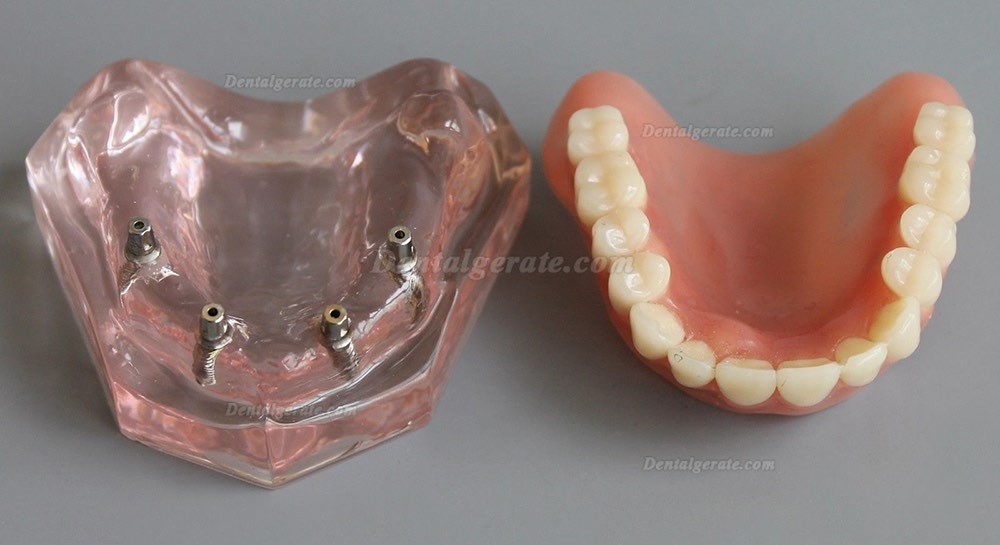 Dental Abnehmbare Overdenture Inferior mit 4 Implantaten Demo Z&auml;hne Studie Modell