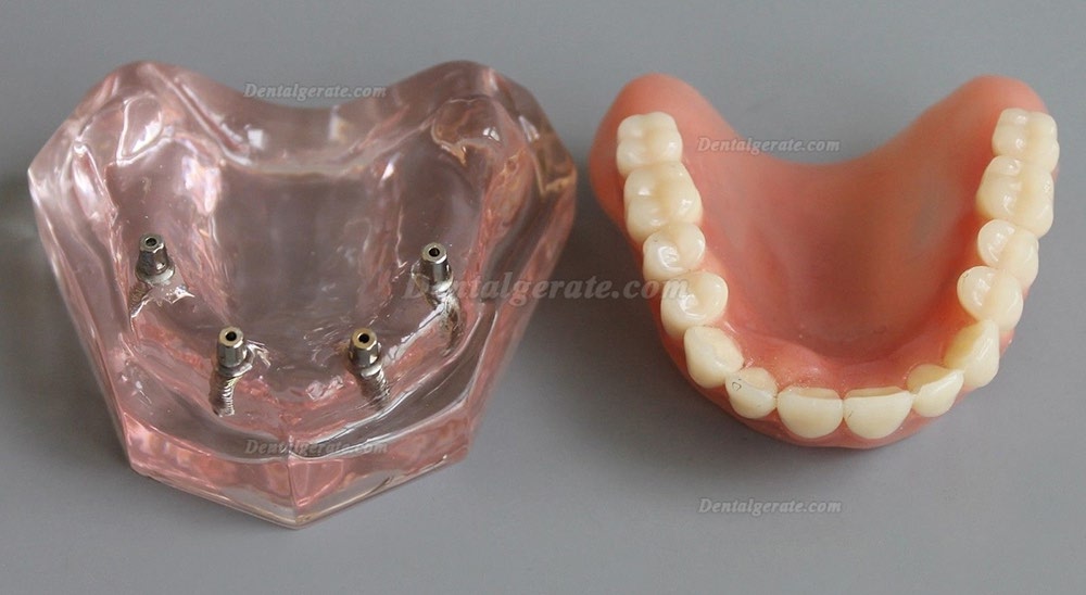 Dental Abnehmbare Overdenture Inferior mit 4 Implantaten Demo Z&auml;hne Studie Modell