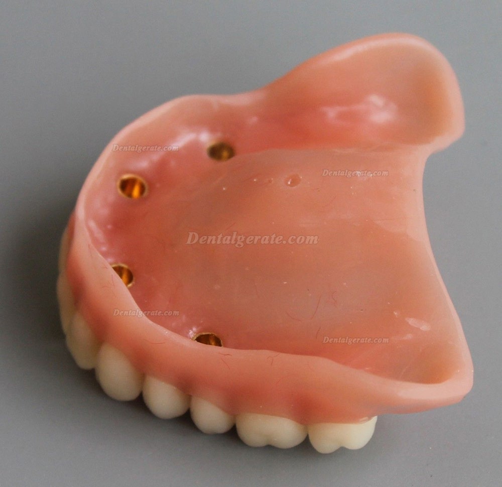 Dental Abnehmbare Overdenture Inferior mit 4 Implantaten Demo Z&auml;hne Studie Modell