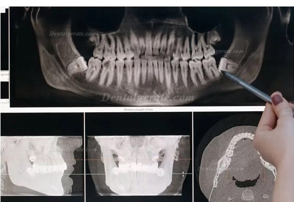 Refine MaxSurgery piezochirurgie ger&auml;t ultraschallchirurgie zahnarzt