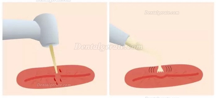 Refine MaxSurgery piezochirurgie ger&auml;t ultraschallchirurgie zahnarzt
