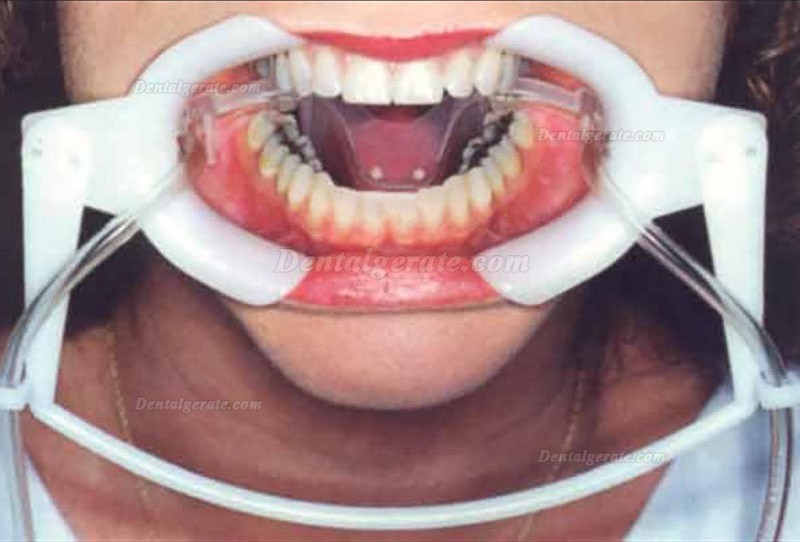 1 Stk. Dental Mund&ouml;ffner mit Speichelsaugrohr (Zahnbleaching wangenretraktor)