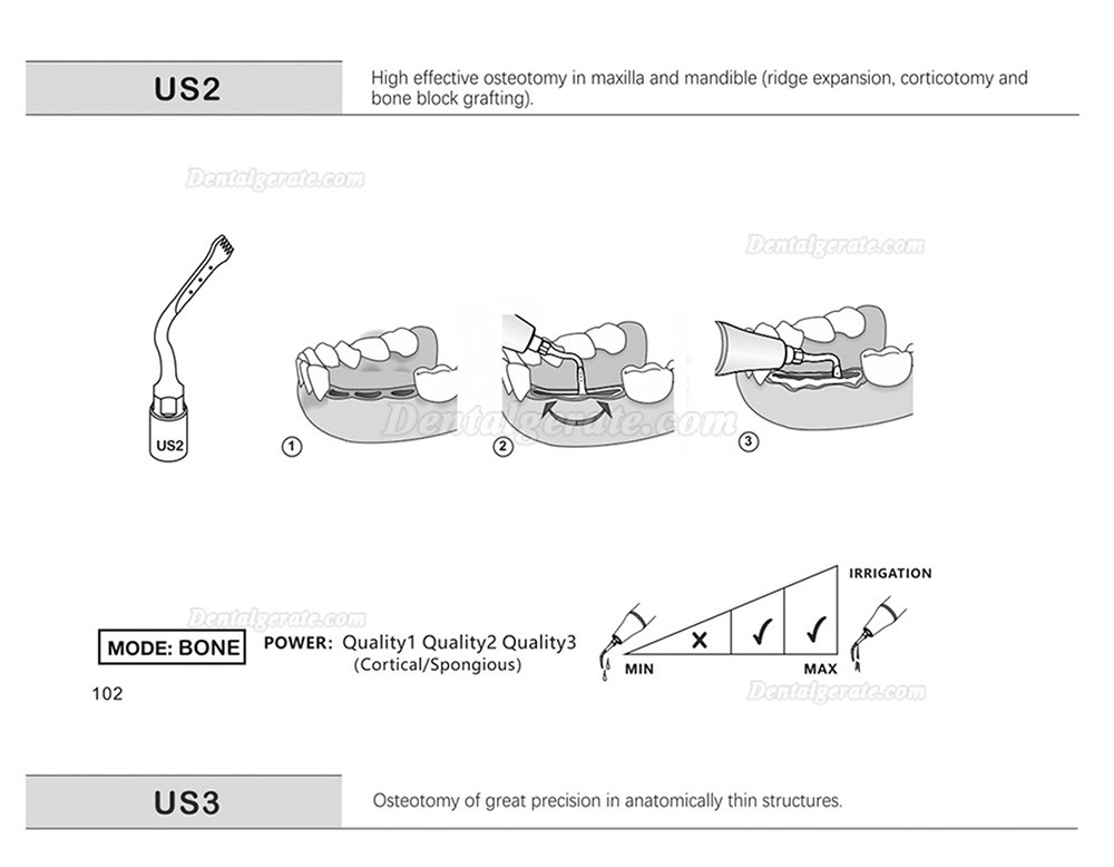 1 St&uuml;cke Refine&reg; Piezosurgery Osteotomie Knochenschneiden Spitze US1 US1L US1R US2 US3 US4 US5 US6 US7 US11 US12 (Kompatibel Mit Mectron Woodpecker)