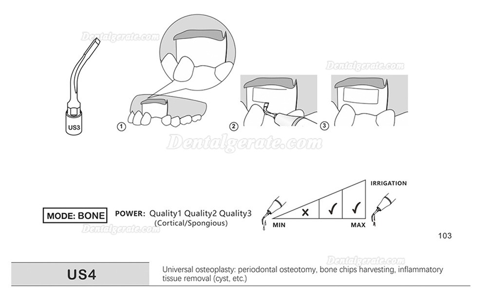 1 St&uuml;cke Refine&reg; Piezosurgery Osteotomie Knochenschneiden Spitze US1 US1L US1R US2 US3 US4 US5 US6 US7 US11 US12 (Kompatibel Mit Mectron Woodpecker)