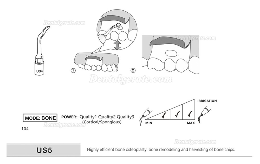 1 St&uuml;cke Refine&reg; Piezosurgery Osteotomie Knochenschneiden Spitze US1 US1L US1R US2 US3 US4 US5 US6 US7 US11 US12 (Kompatibel Mit Mectron Woodpecker)