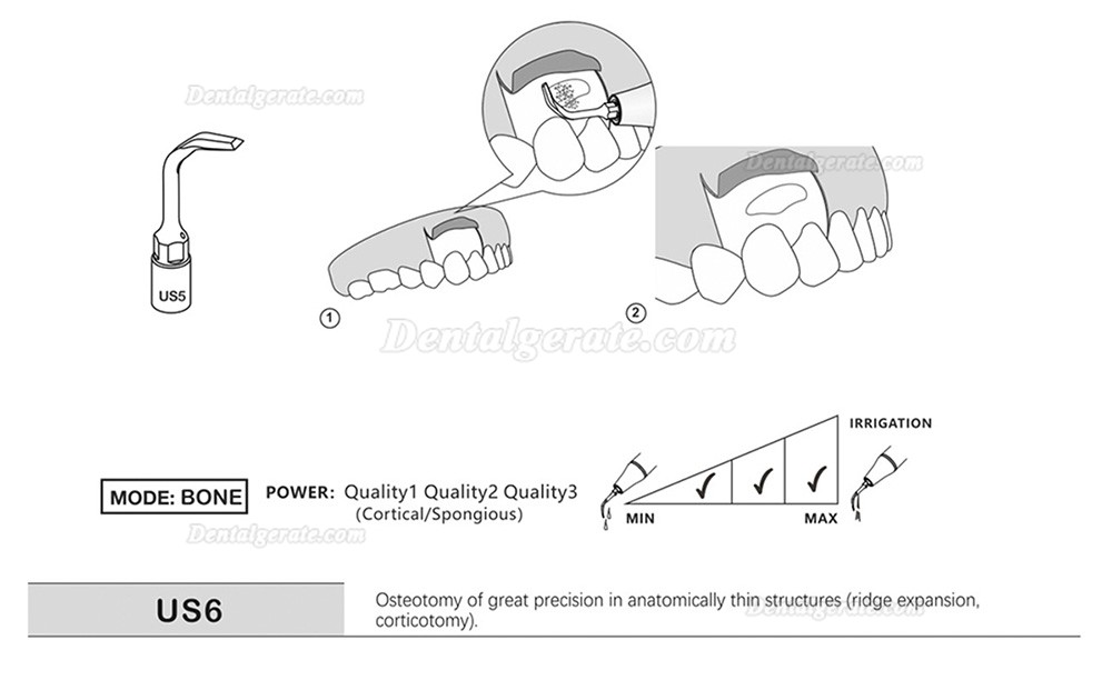 1 St&uuml;cke Refine&reg; Piezosurgery Osteotomie Knochenschneiden Spitze US1 US1L US1R US2 US3 US4 US5 US6 US7 US11 US12 (Kompatibel Mit Mectron Woodpecker)