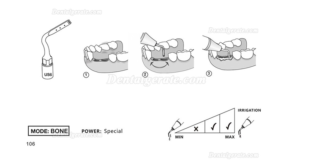 1 St&uuml;cke Refine&reg; Piezosurgery Osteotomie Knochenschneiden Spitze US1 US1L US1R US2 US3 US4 US5 US6 US7 US11 US12 (Kompatibel Mit Mectron Woodpecker)