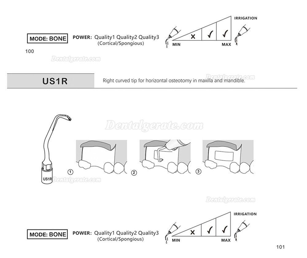 1 St&uuml;cke Refine&reg; Piezosurgery Osteotomie Knochenschneiden Spitze US1 US1L US1R US2 US3 US4 US5 US6 US7 US11 US12 (Kompatibel Mit Mectron Woodpecker)