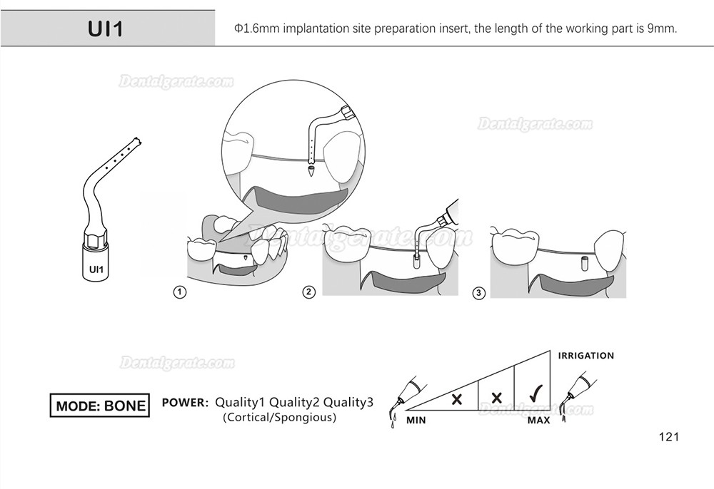 1 Stück Piezochirurgie Spitzen für Implantat Chirurgie Ul1 UI2 UI3 UI4 UI5 (Kompatibel Mit Mectron Woodpecker)