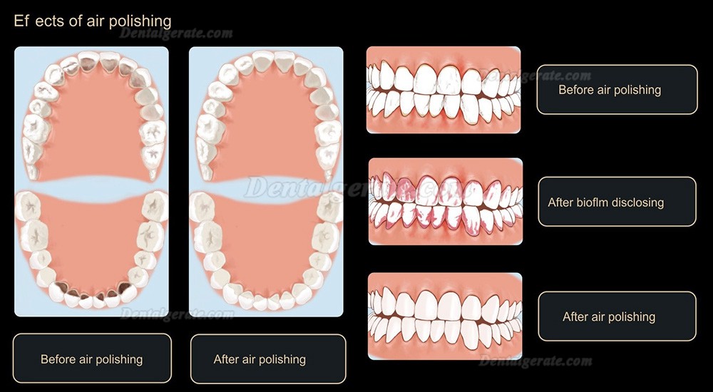 Woodpecker AP-H Plus airflow pulverstrahlger&auml;t zahnarzt, supraGingival / subgingival Handst&uuml;ck 4 Loch