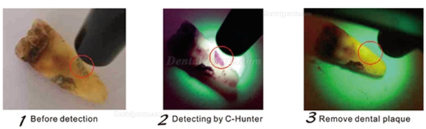 Zahnkariesdetektor C-Hunter Zahnkariesdetektor C-Hunter