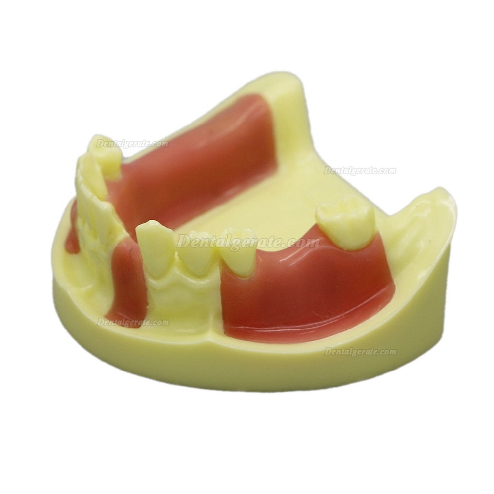 Dental Model # 2004 01 - Unterkieferimplantat-&Uuml;bungsmodell mit Gingiva