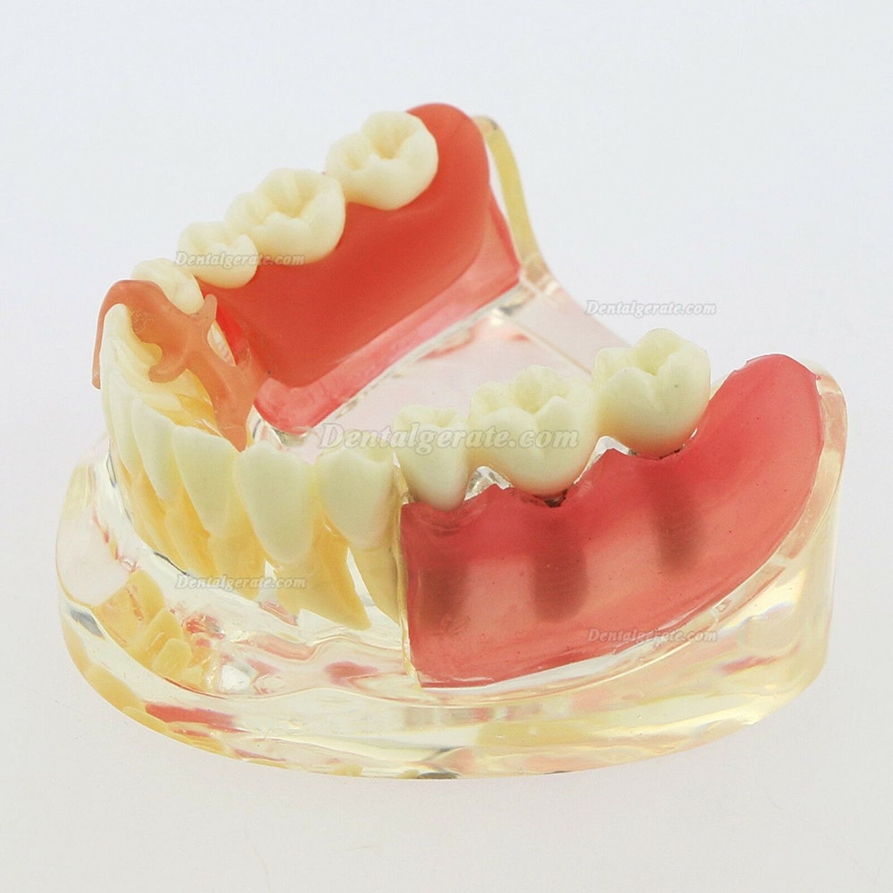 Dental Z&auml;hne Modell minderwertig abnehmbare Restauration Implantatbr&uuml;cke Demo Modell 6006