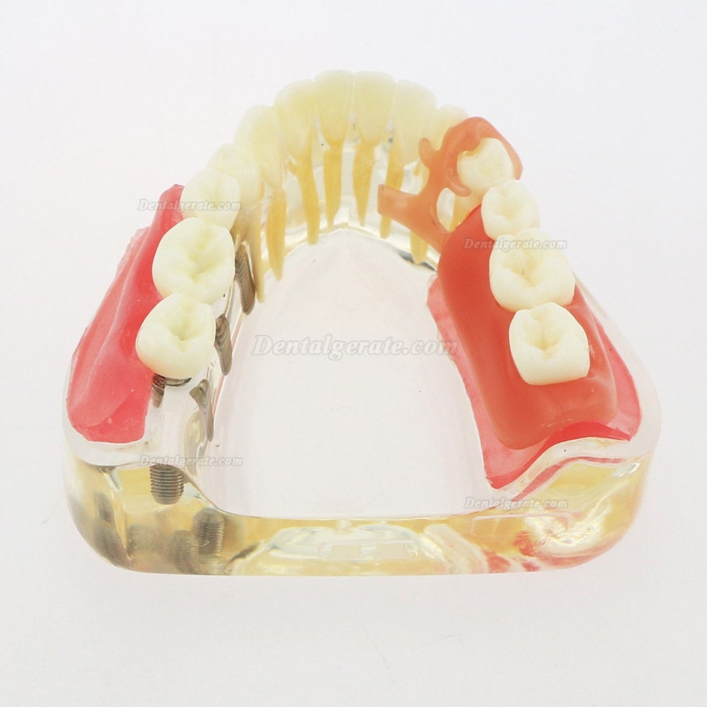 Dental Z&auml;hne Modell minderwertig abnehmbare Restauration Implantatbr&uuml;cke Demo Modell 6006