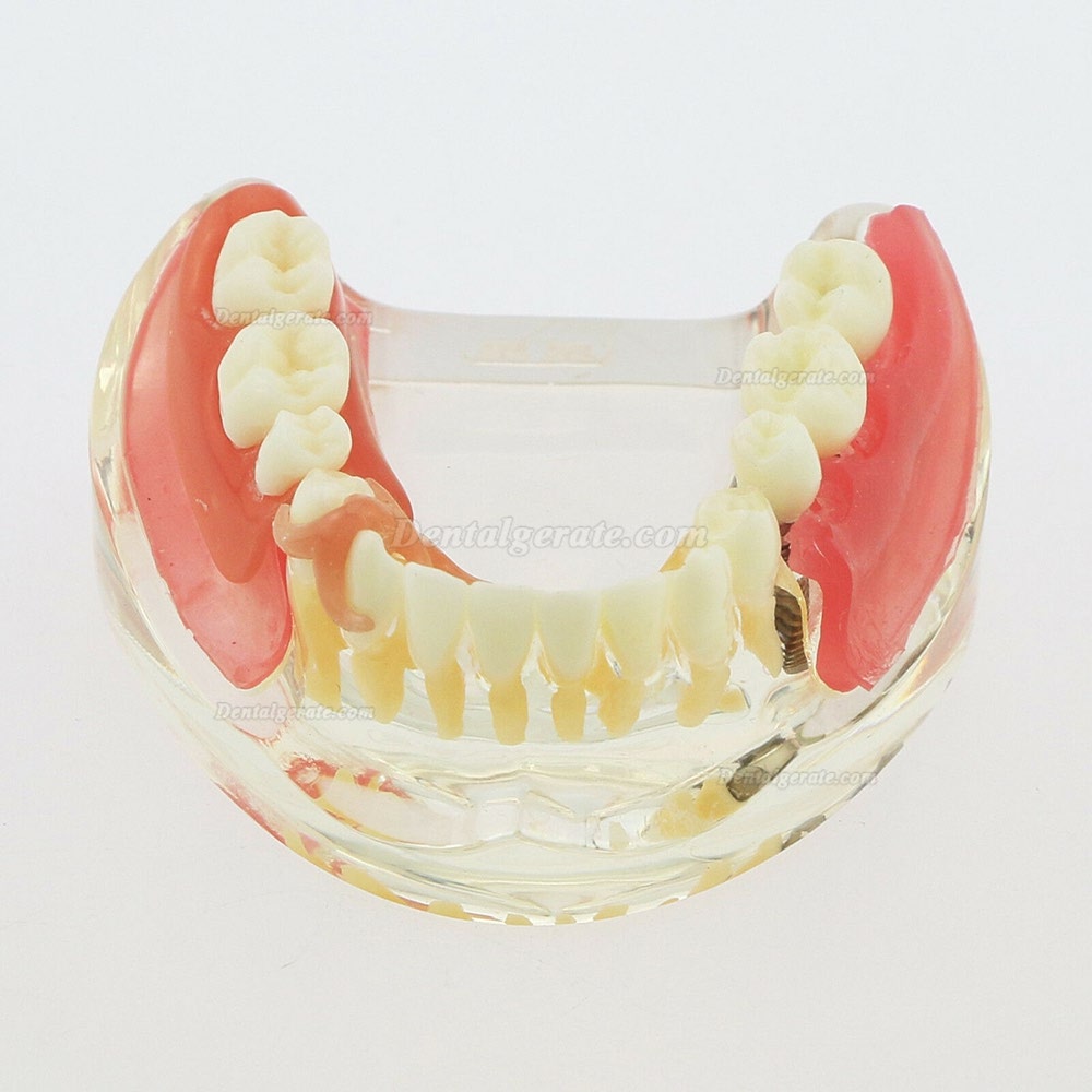 Dental Z&auml;hne Modell minderwertig abnehmbare Restauration Implantatbr&uuml;cke Demo Modell 6006