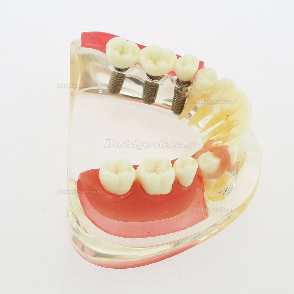 Dental Z&auml;hne Modell minderwertig abnehmbare Restauration Implantatbr&uuml;cke Demo Modell 6006