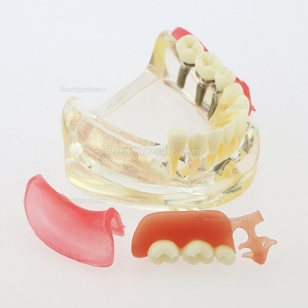 Dental Z&auml;hne Modell minderwertig abnehmbare Restauration Implantatbr&uuml;cke Demo Modell 6006