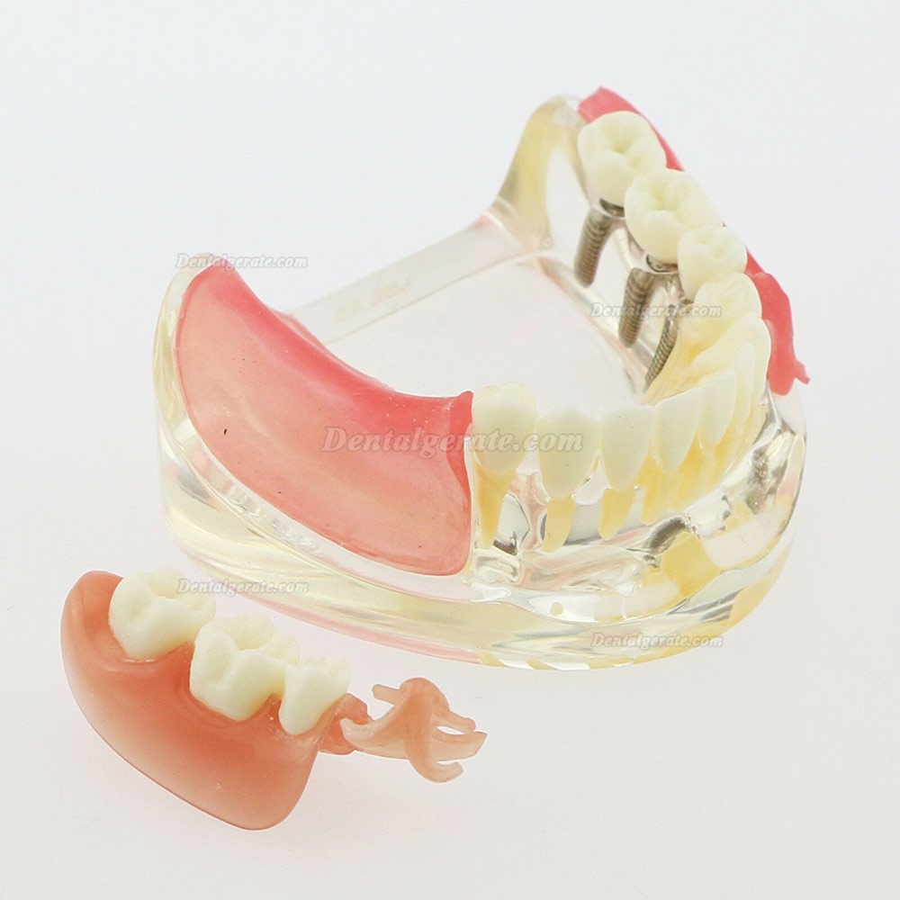 Dental Z&auml;hne Modell minderwertig abnehmbare Restauration Implantatbr&uuml;cke Demo Modell 6006