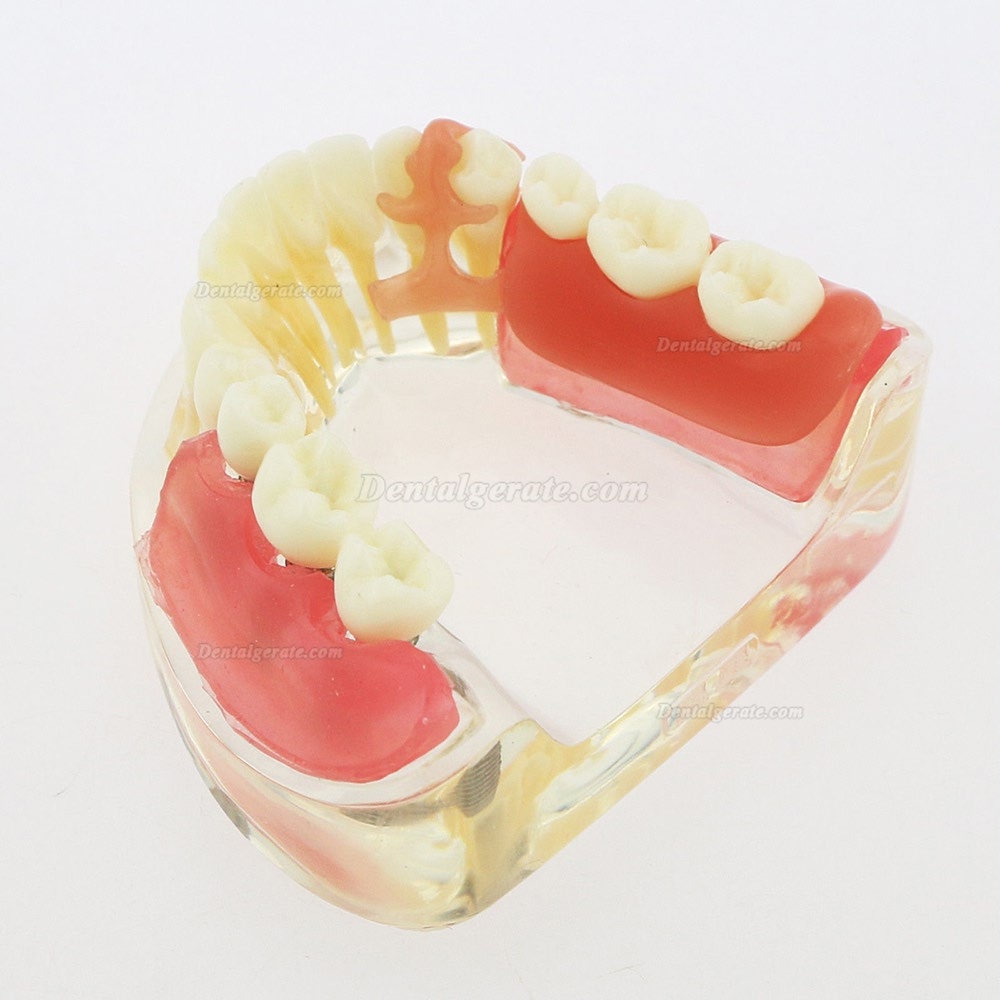 Dental Z&auml;hne Modell minderwertig abnehmbare Restauration Implantatbr&uuml;cke Demo Modell 6006